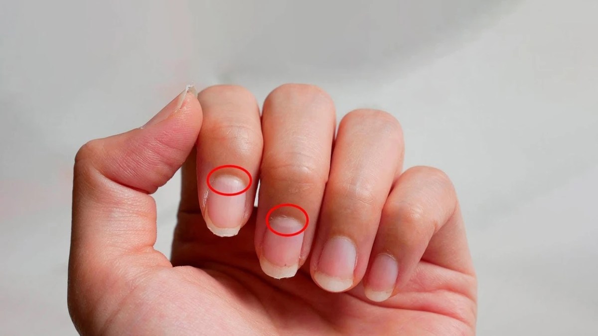 Nëse ju zhduken këto gjysmëhëna në thonj  mund të jetë shenjë e hershme e sëmundjes