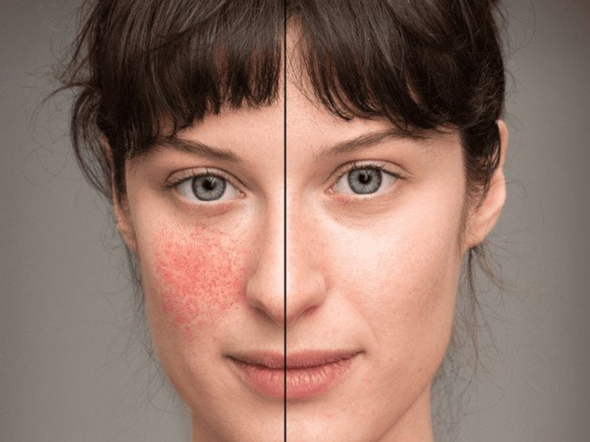 ​Dita Botërore e “Lupus”