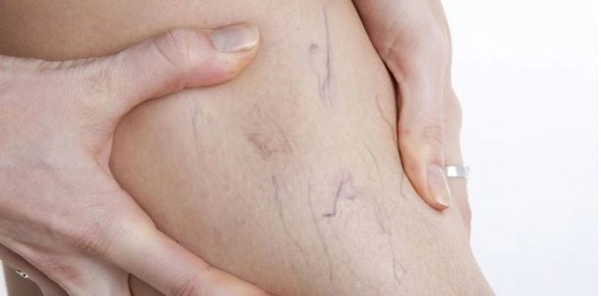 5 mite dhe të vërteta rreth sëmundjeve venoze