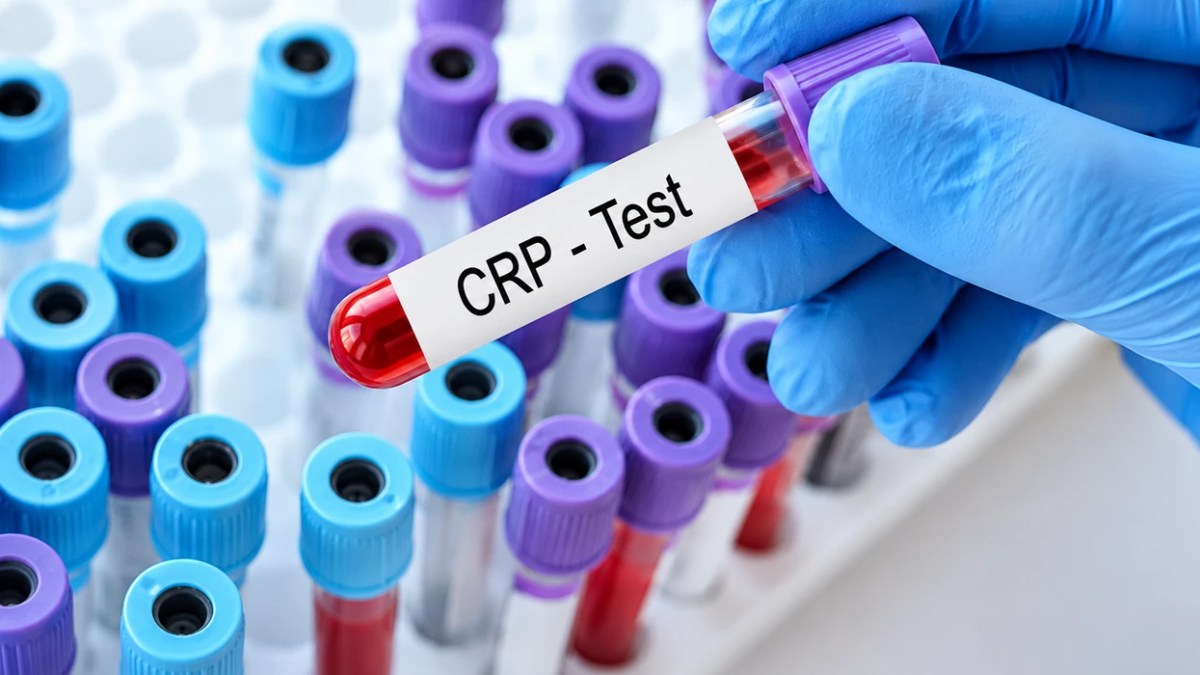Proteina C-reaktive: A duhet ta bëjnë edhe të shëndetshmit këtë analizë të gjakut?