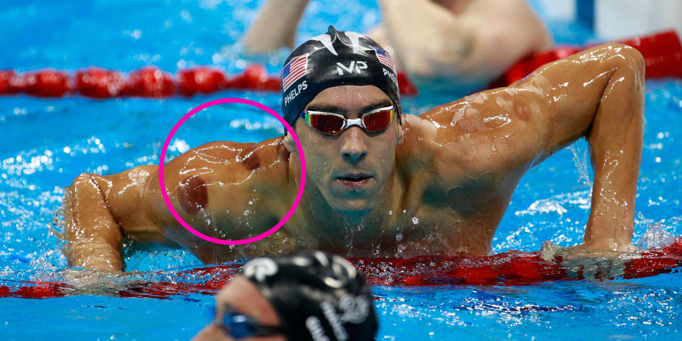 Mike-Phelps-Cupping